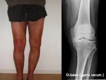Knie artrose binnenkant