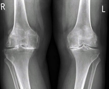 Slijtage of artrose beide knieen