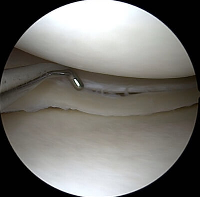 Acuut gescheurde meniscus