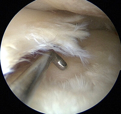 degeneratieve meniscus scheur