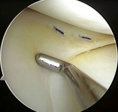 meniscopexie meniscus hechting