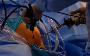 meniscus operatie en behandeling